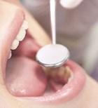 טיפול בסרטן הפה ובריאות השיניים-תמונה